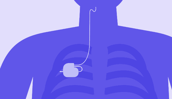 Illustration of a pacemaker implanted in chest.