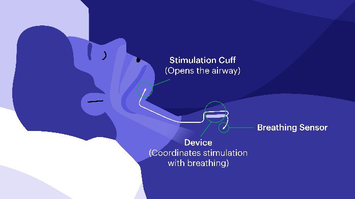 Illustration of sleep apnea device.